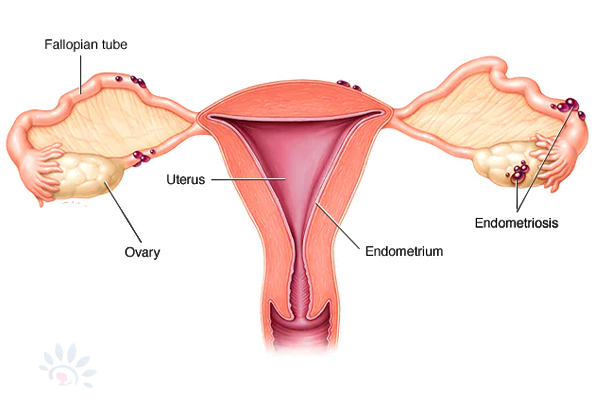 EndometriosisDetails