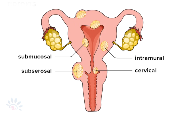 FibroidsDetails.