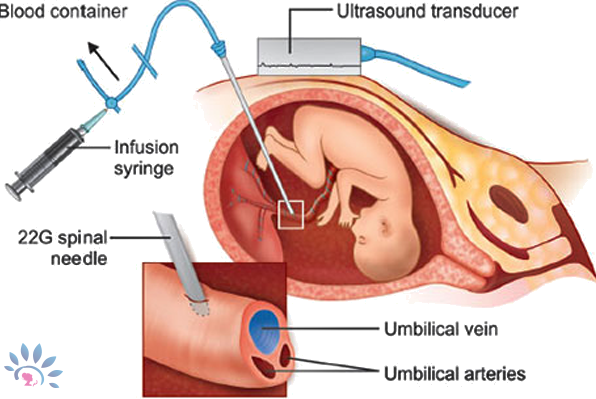 IntrauterineTransfusionDetails
